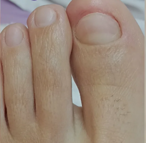 Después del tratamiento de Onicomicosis (hongo)